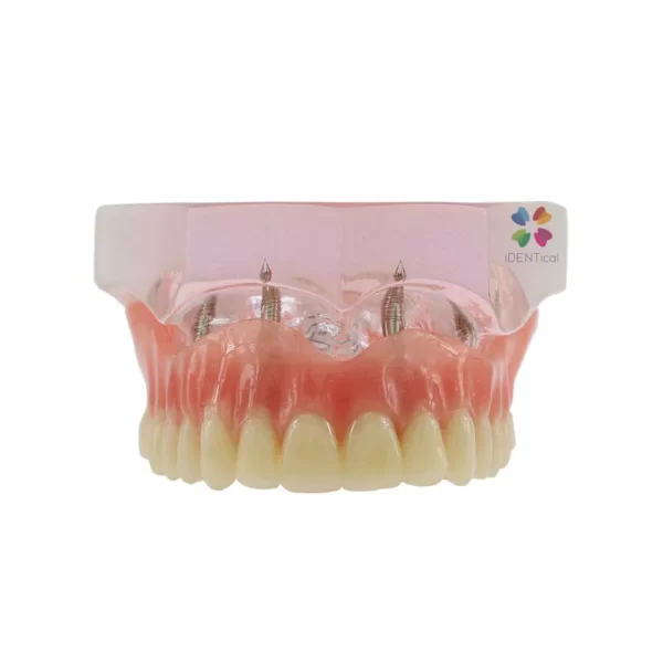 iDENTical Dental Model for Overdenture Maxilla M6001