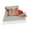 iDENTical Diseased Teeth and Gums Model M4029